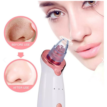 Maquina De Succión Puntos Negros